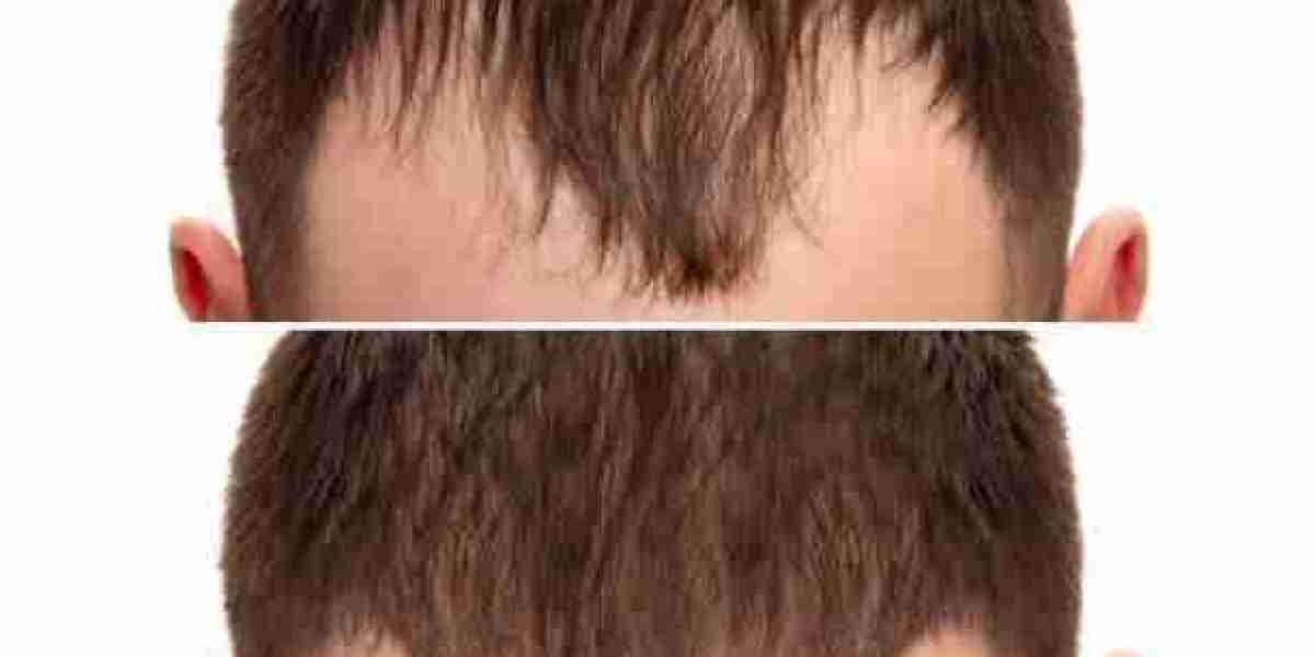 Hair Transplant in Dubai with Proven Hair Restoration