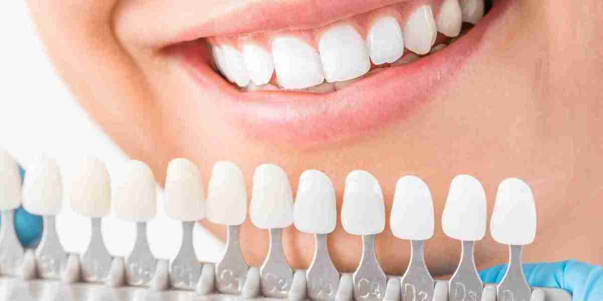 Veneers Dubai: Complete Guide to a Perfect Smile Makeover