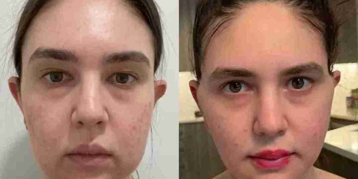 Best Buccal fat removal Surgeons in dubai ensure optimal healing