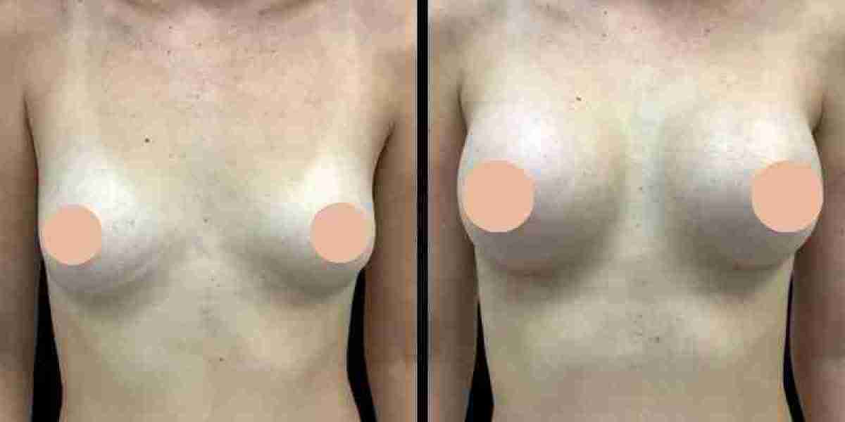 Recovery Guidance Provided by the Best Breast Augmentation Surgeon in Dubai