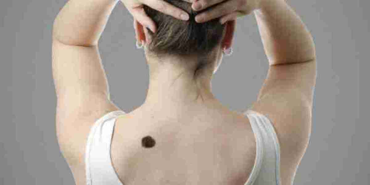 Birthmark Removal in Dubai: Precision Laser Technology