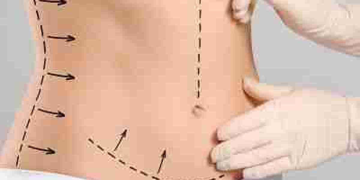 Tummy Tuck in Dubai: Comprehensive Body Contouring