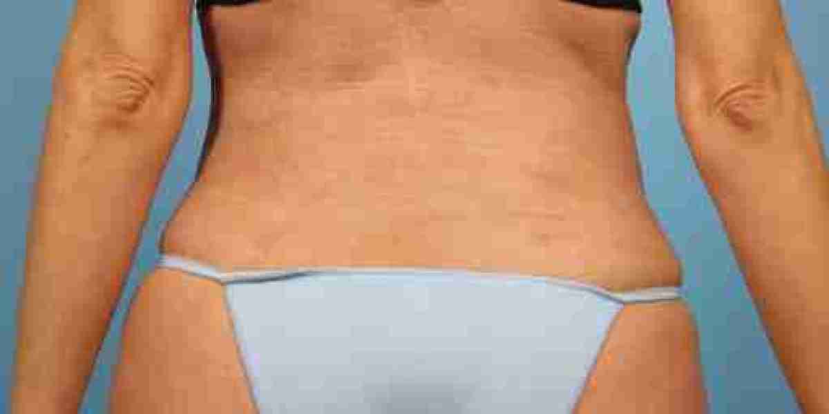 Benefits of Buttock Augmentation in Dubai Treatment
