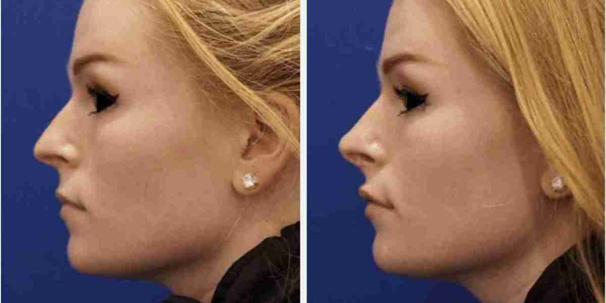 Liquid Rhinoplasty in Dubai Without Traditional Surgery