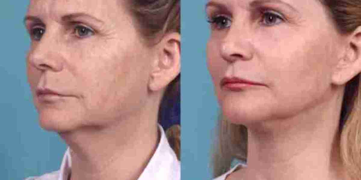 Chemical Peel Treatments in Dubai: What to Avoid After Treatment