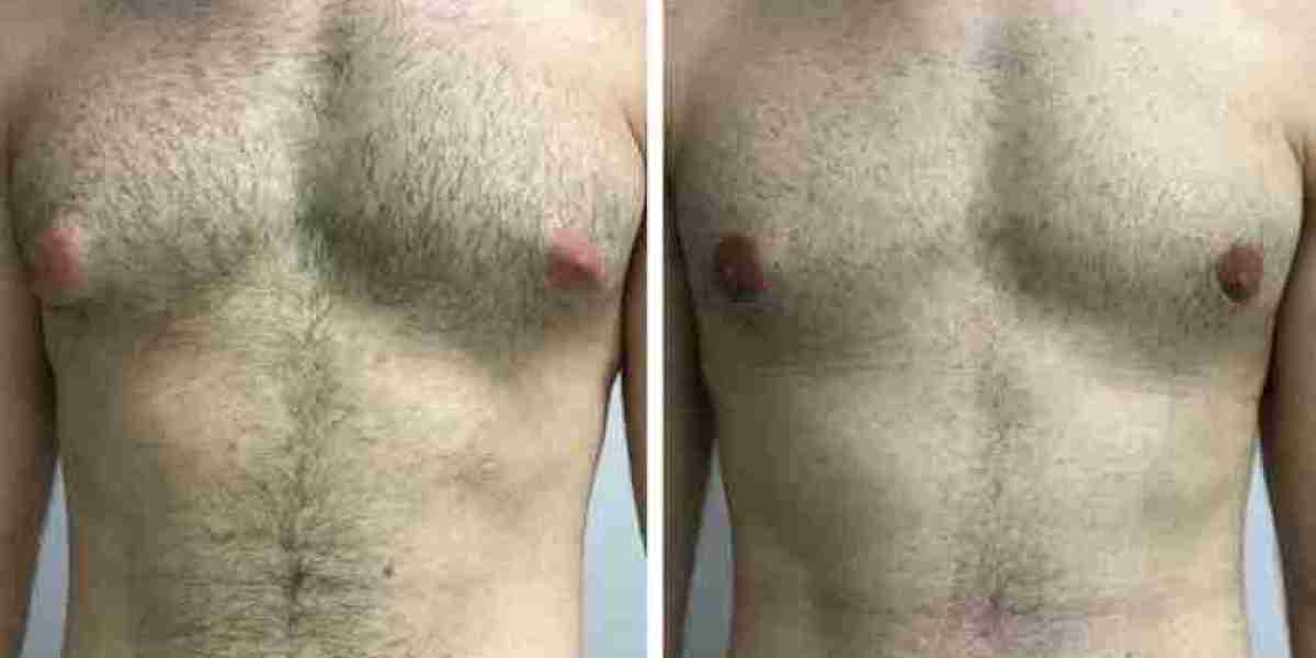 Gynecomastia Surgery in Dubai: A Comprehensive Guide to Achieving a Masculine Chest