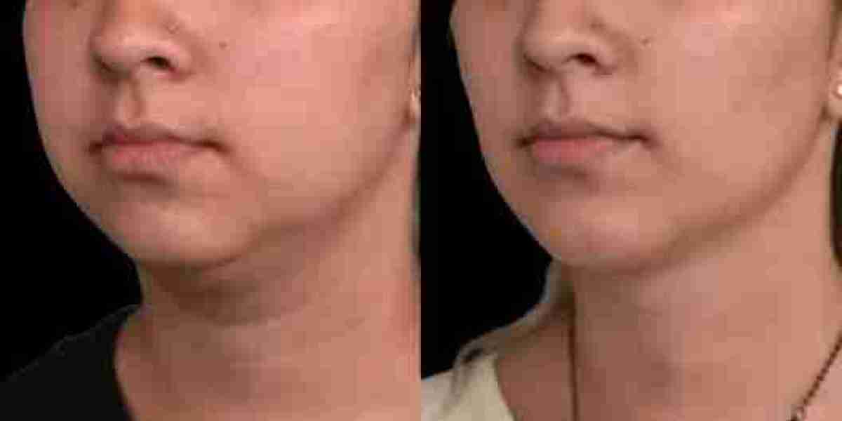 Best Double chin removal Surgeon in dubai Why!