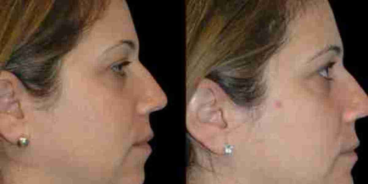 Best Double chin removal Surgeons in dubai Ultimate Guide