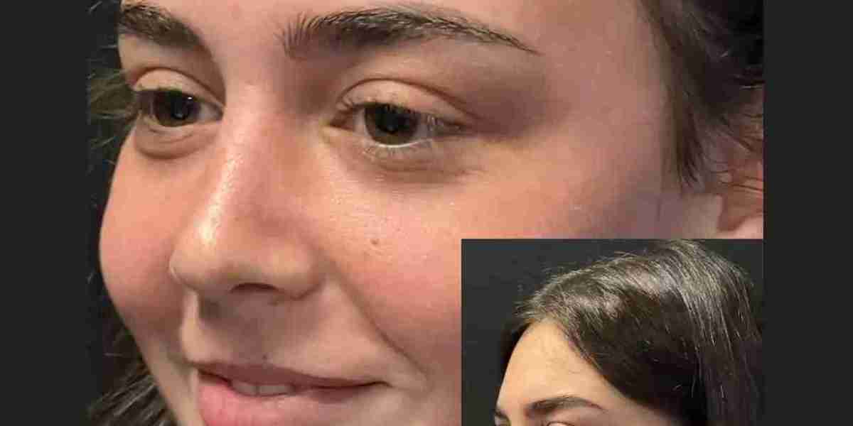 Nose Surgery in Dubai: How Age Can Influence Surgical Results