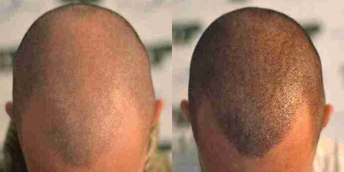 Hair Transplant Dubai: Precision Follicular Grafting