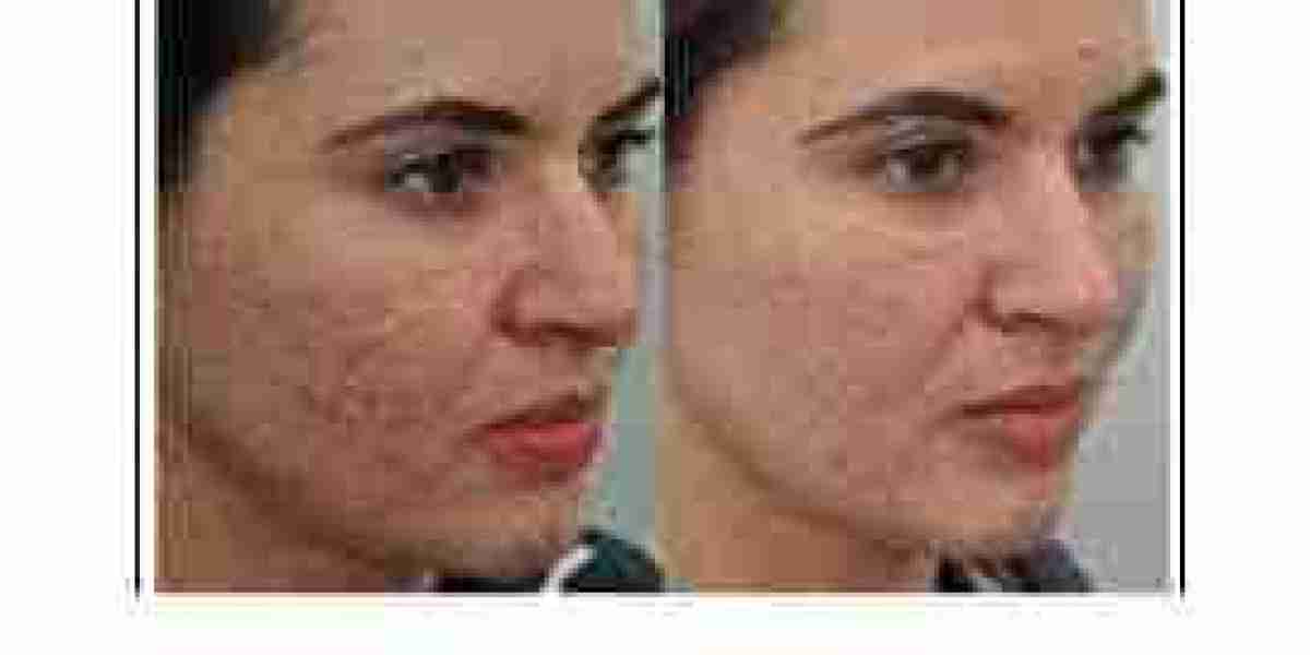Fractional CO2 Laser Treatment in Dubai for Acne Scar Improvement | Complete Guide