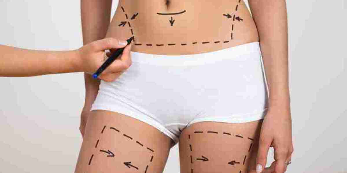 Liposuction Surgery in Islamabad: A Complete Guide to Achieving Your Ideal Body Shape