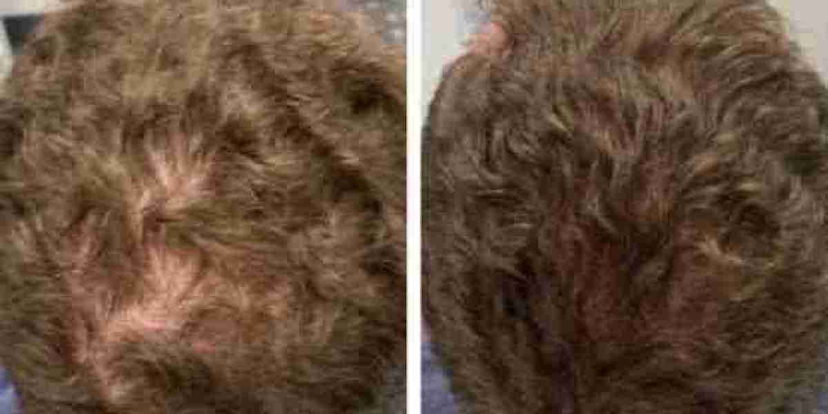 Advanced Regenerative Treatment for Hair Renewal