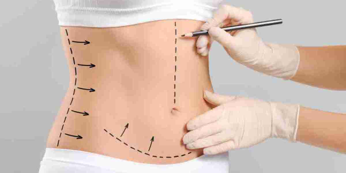 Tummy Tuck in Islamabad: Everything About Recovery and Long-Term Results