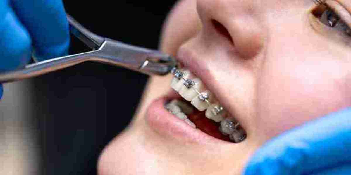Braces in Pakistan Cost: Hidden Factors That Can Affect Your Total Treatment Budget