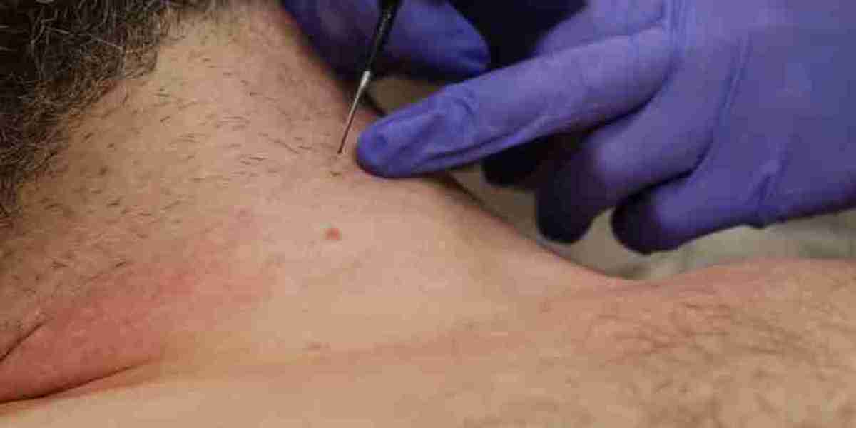 Skin Lesion Removal in Dubai for Better Skin Confidence