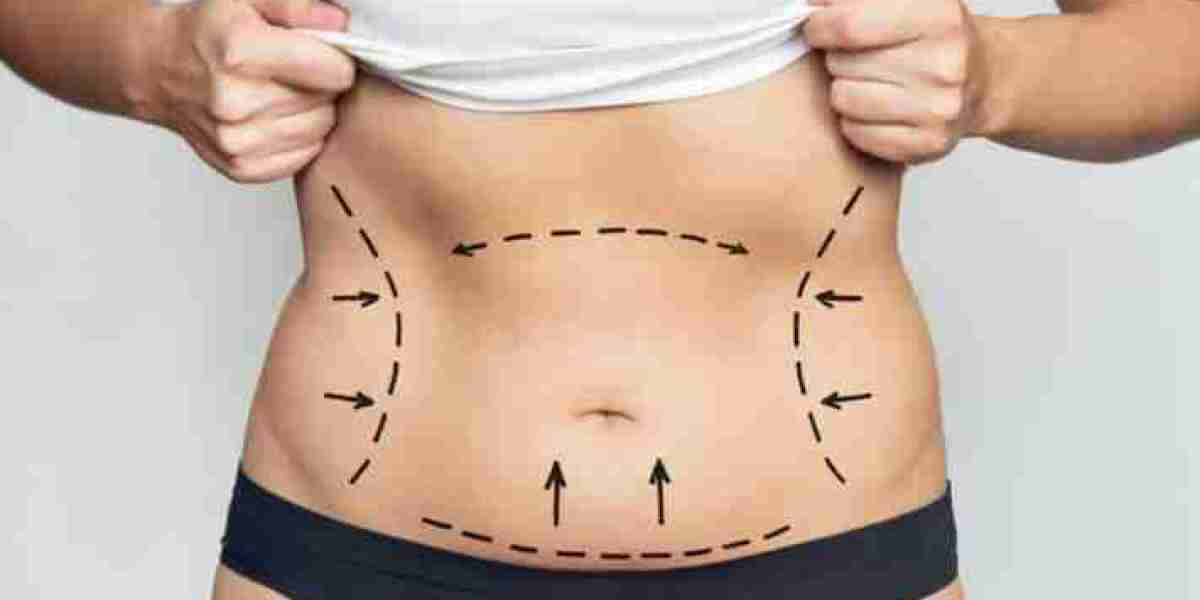 Best Doctors in Dubai for Liposuction: Enhancing Body Contours with Precision