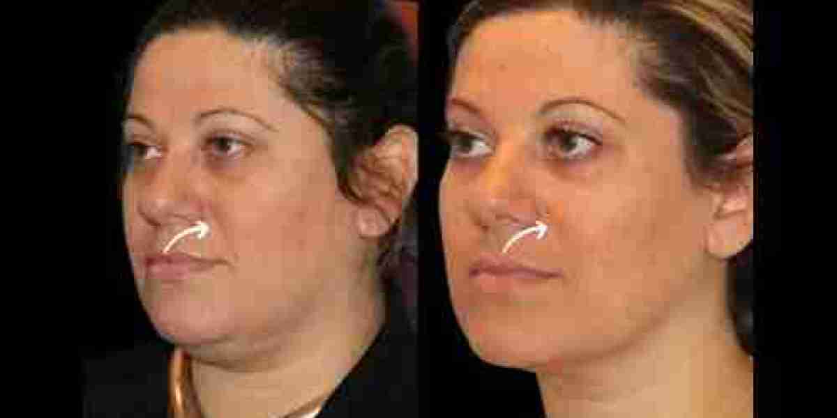 Sculptra Fillers Treatment in Dubai for Deep Tissue Aging Changes