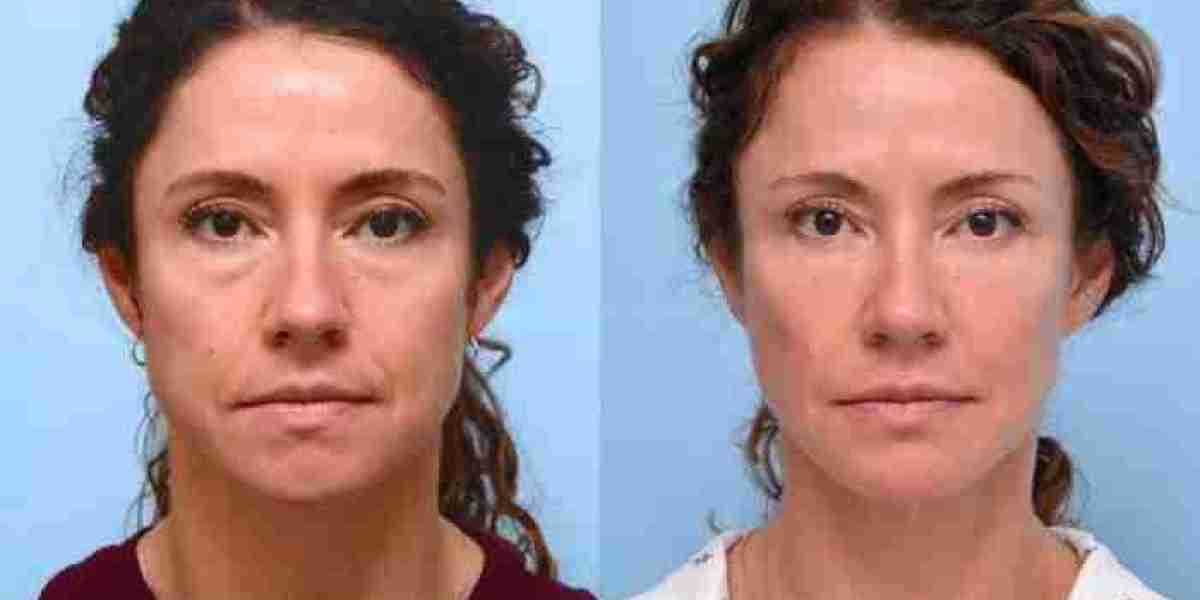 Best Plastic Surgeon in Dubai: Natural Looking Results Through Thread Lift