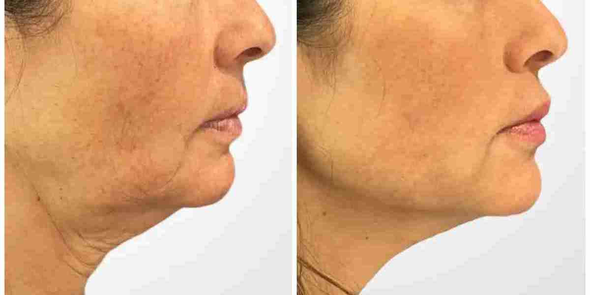 Thread Lift Treatments in Dubai: Effective Skin Tightening With Minimal Discomfort