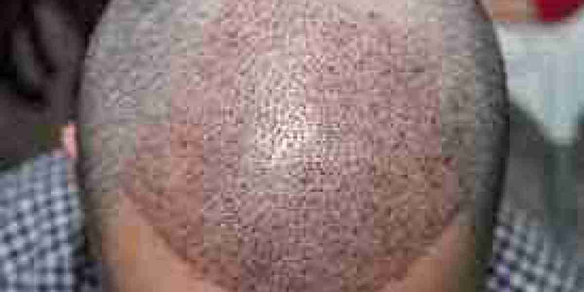 What Should You Look for When Comparing Hair Transplant Clinics in Dubai?