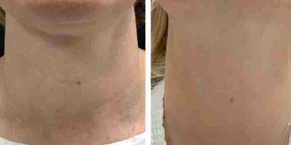 Radiofrequency (RF) Microneedling treatments in Dubai for Advanced Laser Therapy