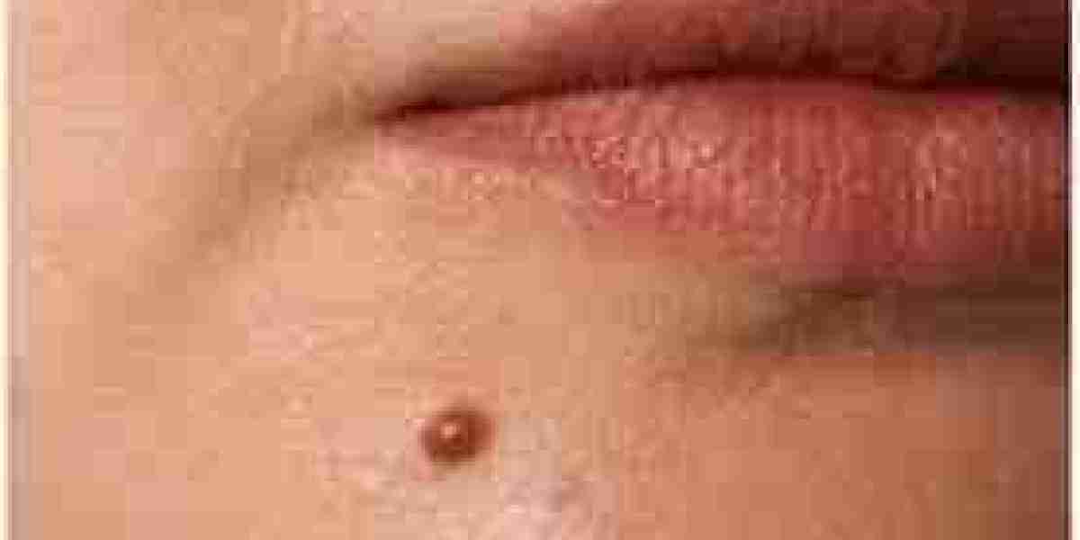 Mole Removal in Dubai | Choosing the Right Treatment