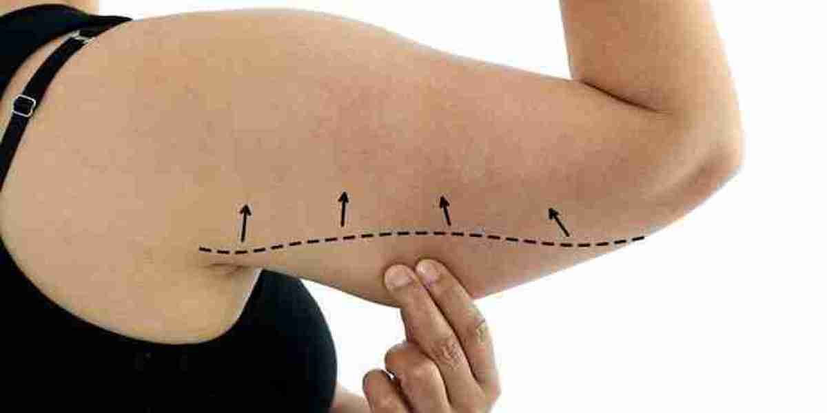 Arm Lift Surgery in Dubai: Refining Your Profile