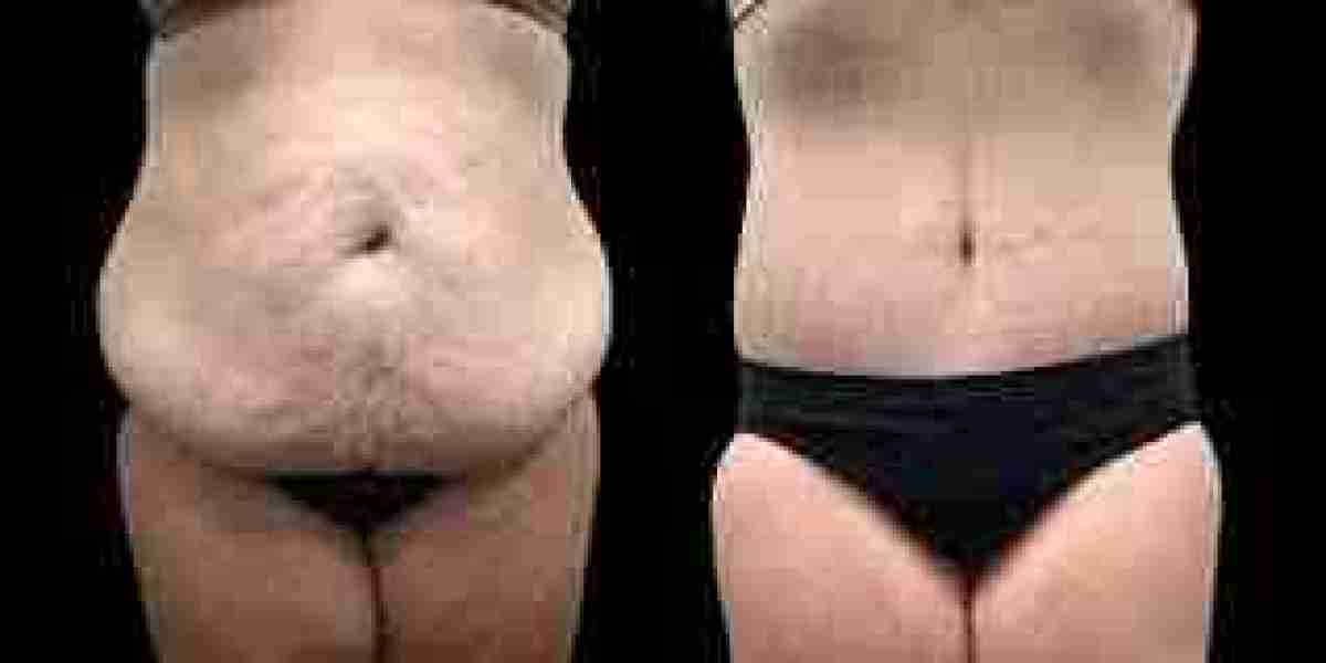 Post-Weight Loss Surgery Consultation in Dubai: What Questions Should You Ask?