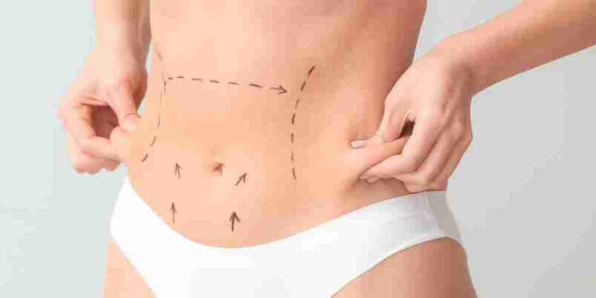 Liposuction in Pakistan: The Most Frequently Asked Questions Answered