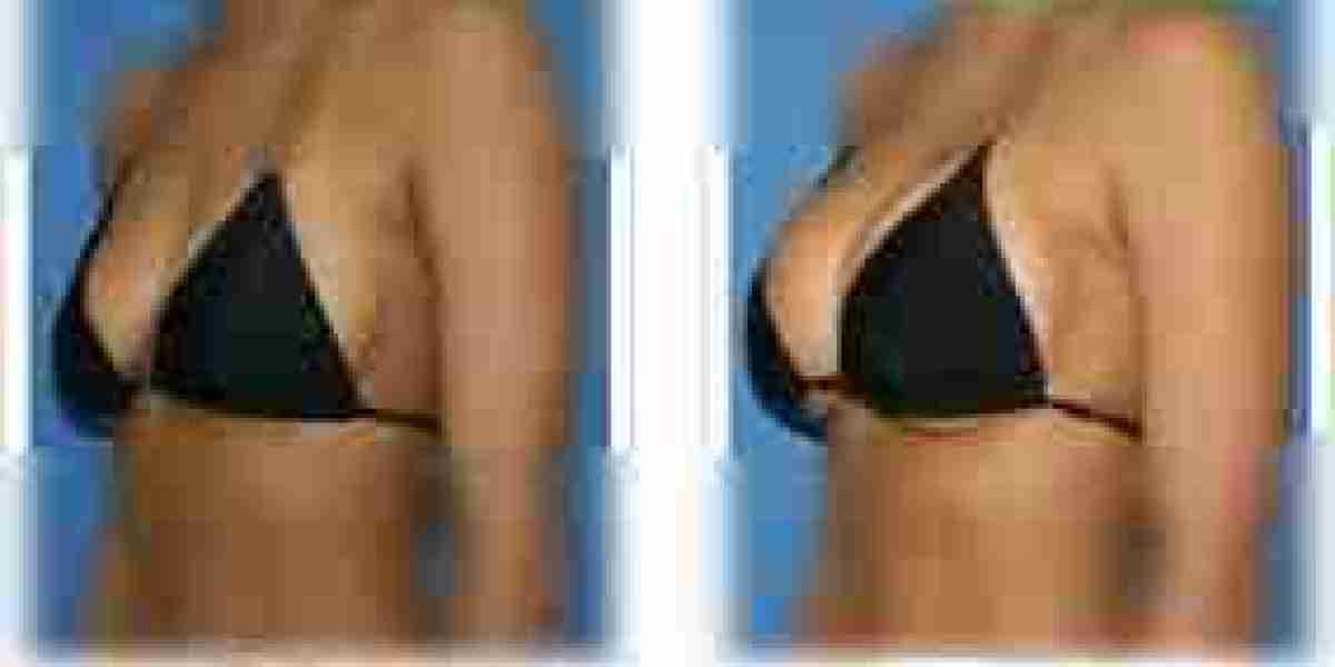 Breast Surgery in Dubai | Augmentation, Reduction & Lift Guide
