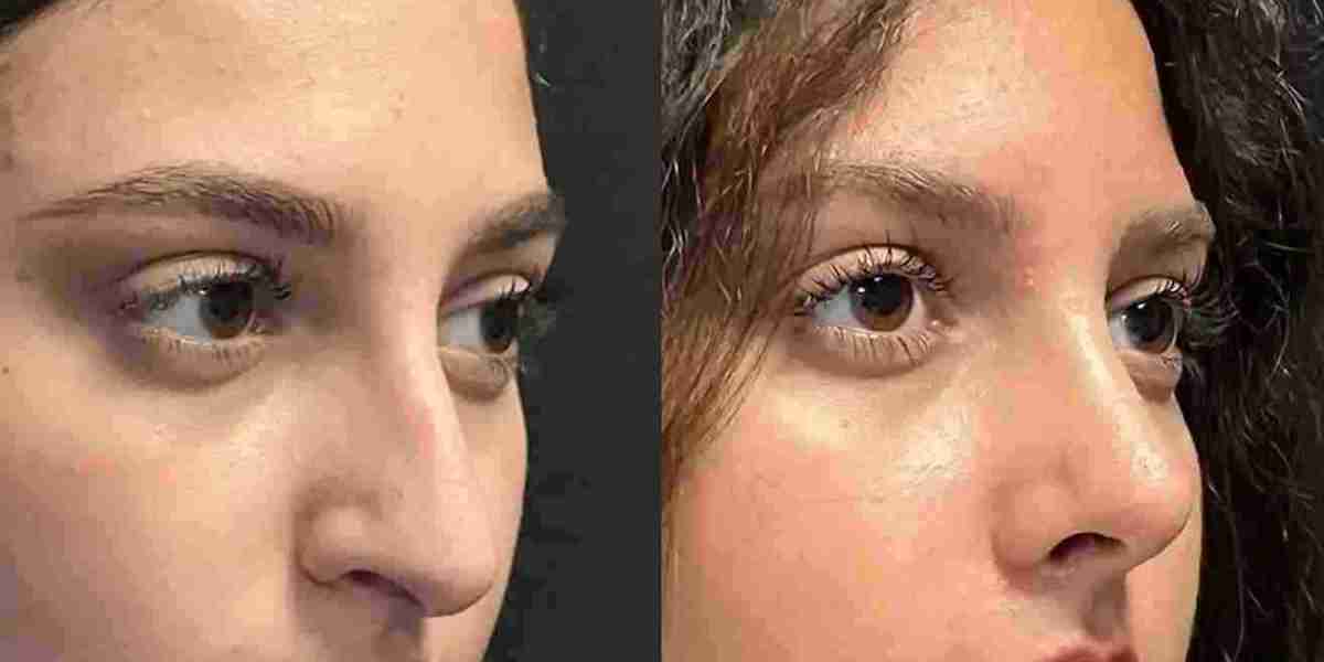 Can Best Doctors in Dubai Refine Your Rhinoplasty Journey?