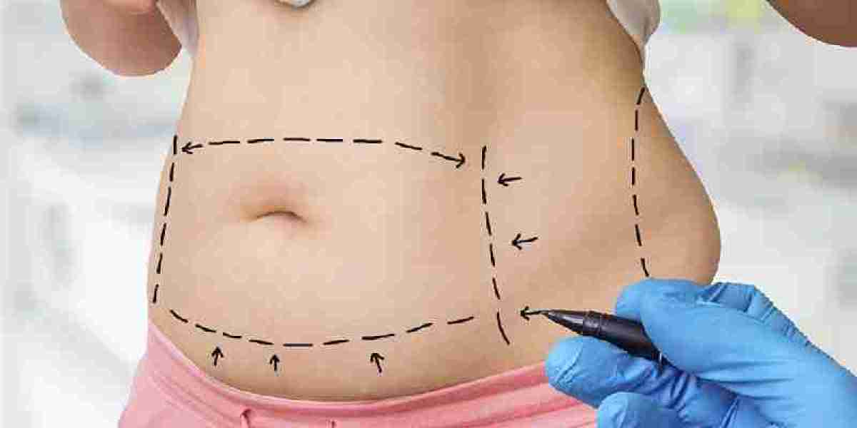 Liposuction Surgery Pakistan: The Most Common Treatment Areas Explained