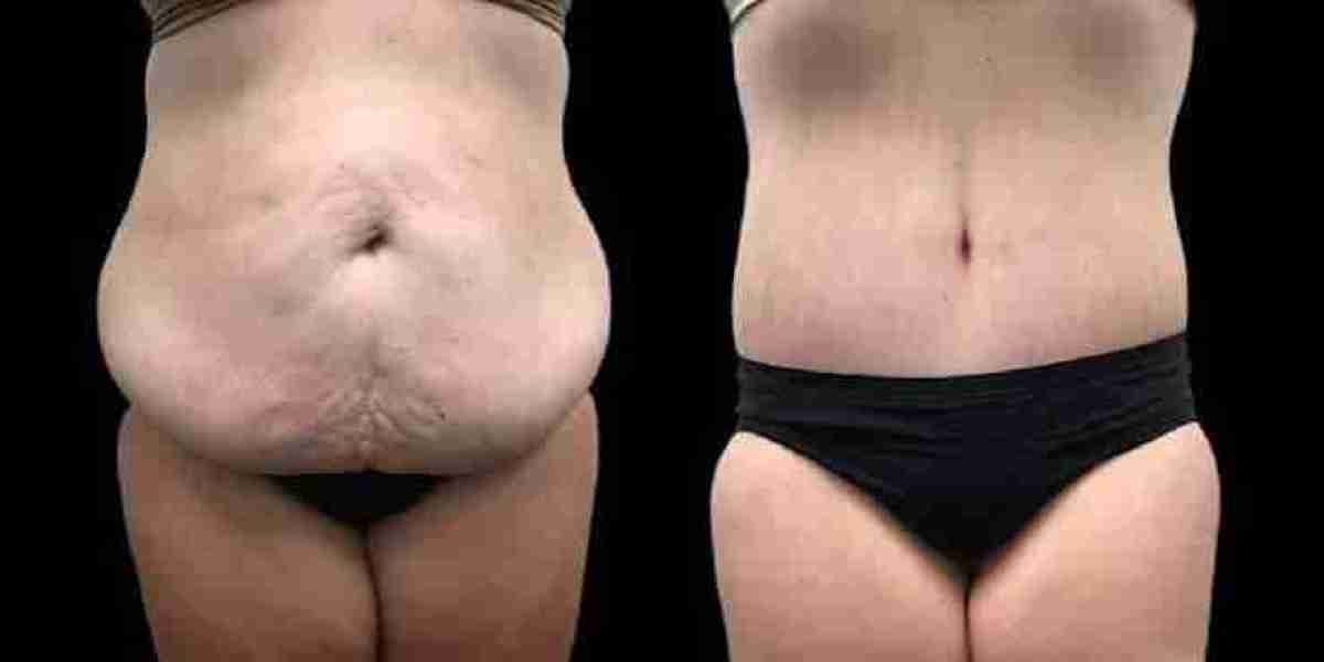 Post-Weight Loss Surgery in Dubai | Complete Guide
