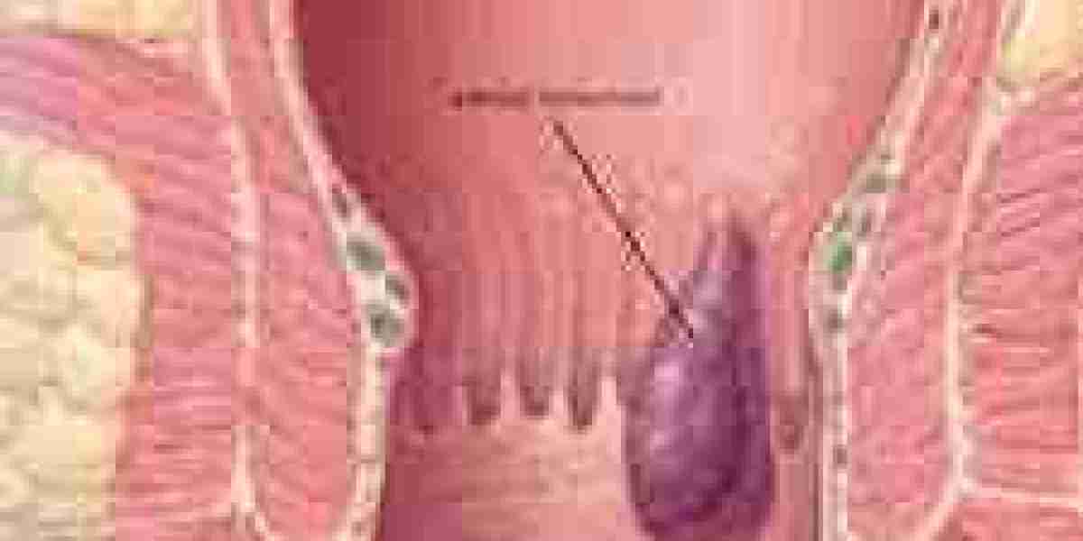 Advanced Haemorrhoids Treatment in Dubai for Lasting Relief