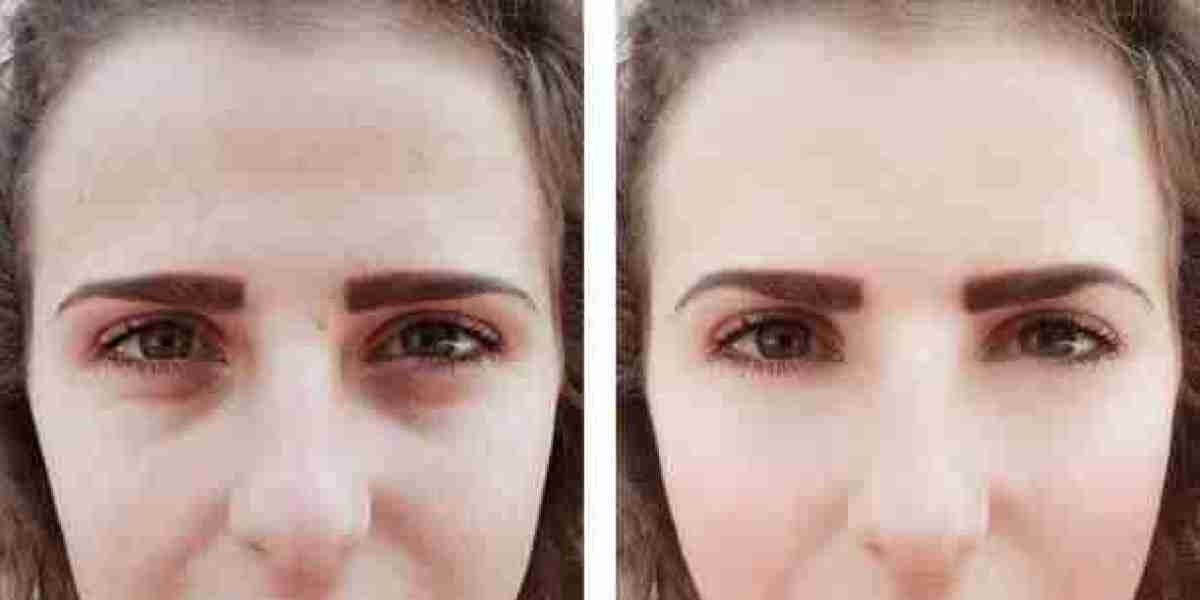 Redensity 2 Filler Injections in Dubai for Natural Results