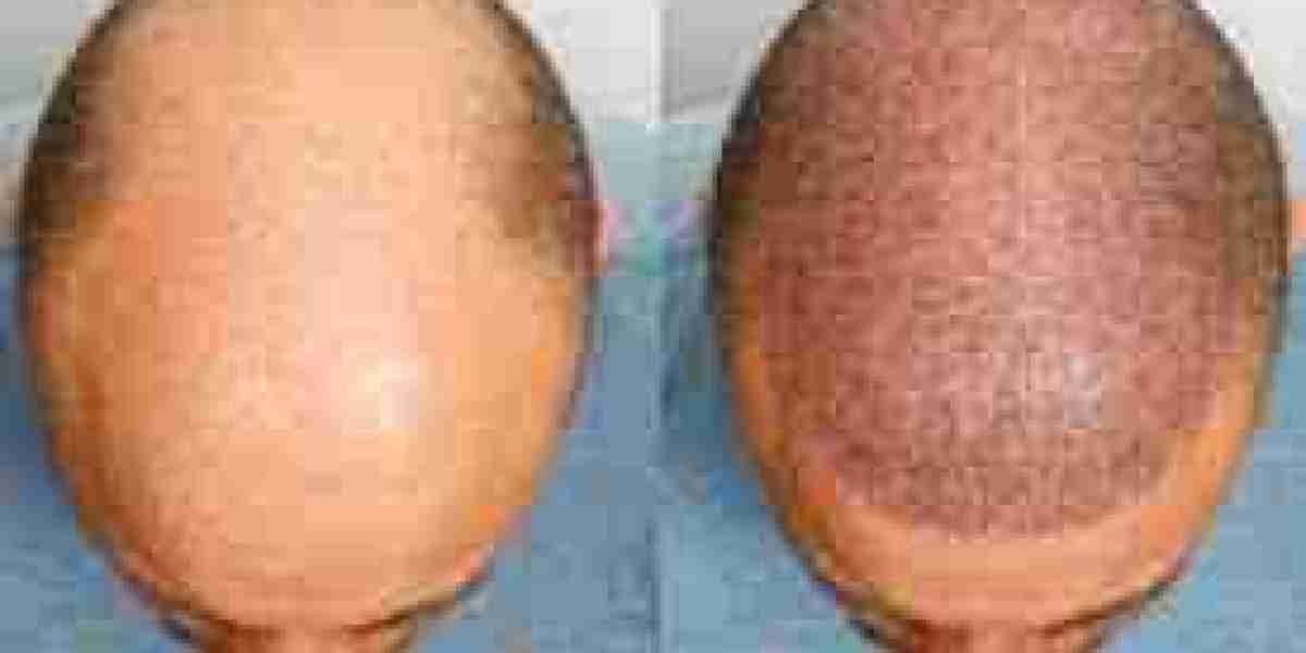 Hair Transplant in Dubai: Modern Hair Restoration Techniques