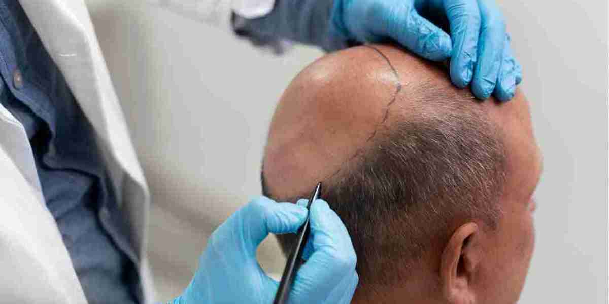 Hair Transplant: Restore Your Confidence with Neotis Skin Clinic
