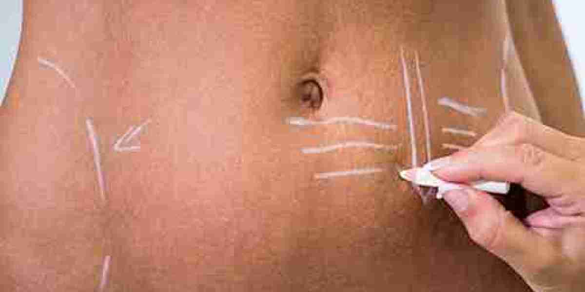 Benefits and Limitations of Mini Tummy Tuck | Dubai Guide