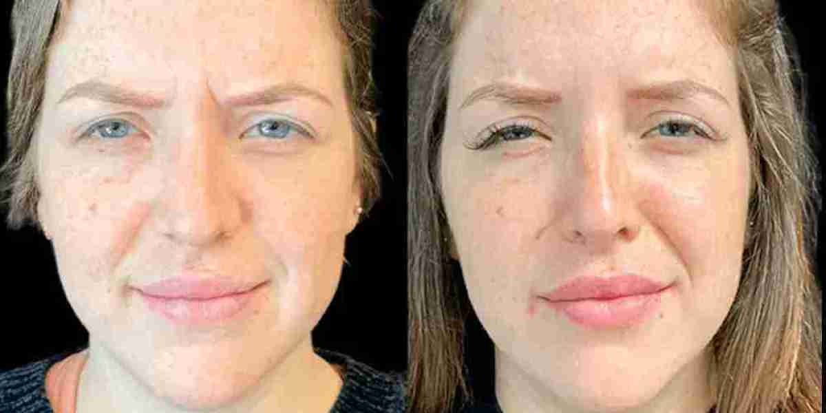 Botox Treatment in Dubai: How to Prepare Before Your Treatment