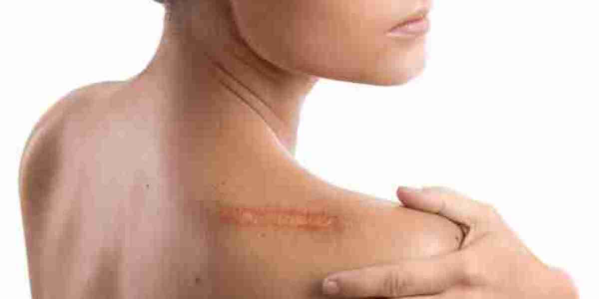Keloid Treatment in Islamabad: Safe and Advanced Scar Management Options