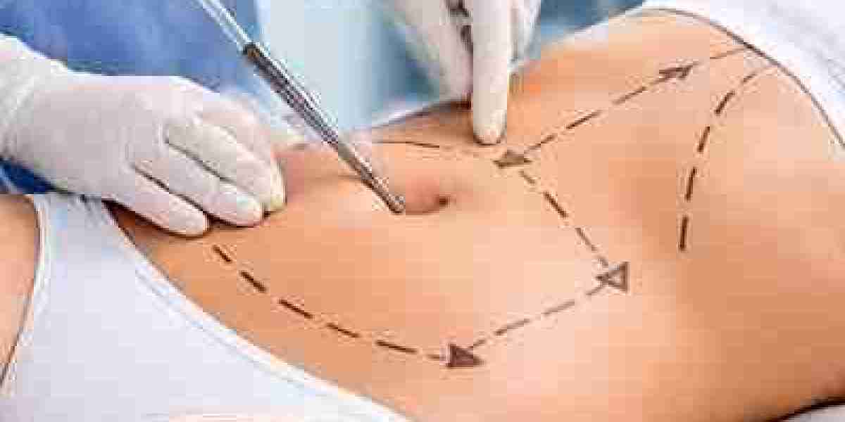 Liposuction Surgery in Dubai: Precision Fat Removal for Balanced Body Contours