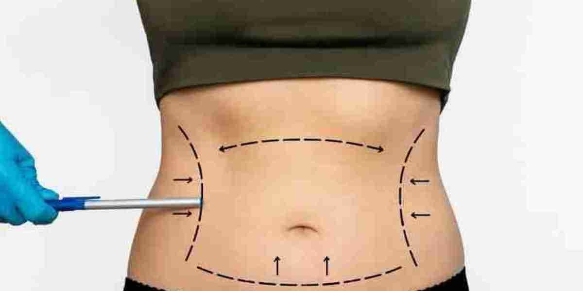 Custom Tummy Tuck in Dubai: Smooth & Sculpted