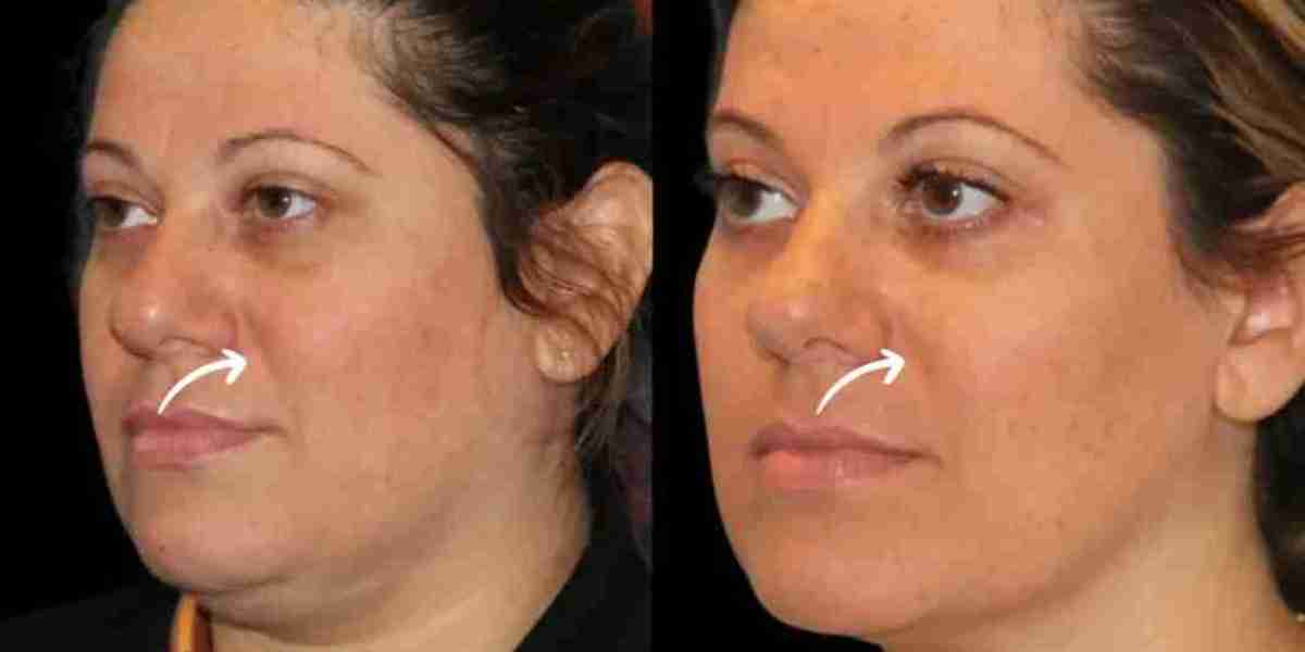 Best Doctors in Dubai Discuss Sculptra for Cervicomental Angle