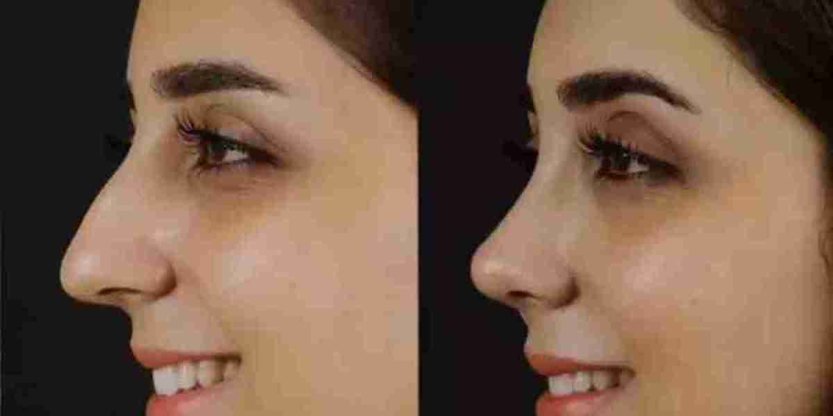 Why Do Patients Trust the Best Doctors in Dubai for Septoplasty?