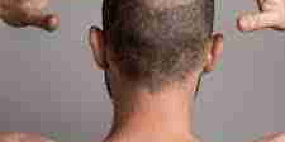 Hair Transplant in Dubai: Is It Right for You?