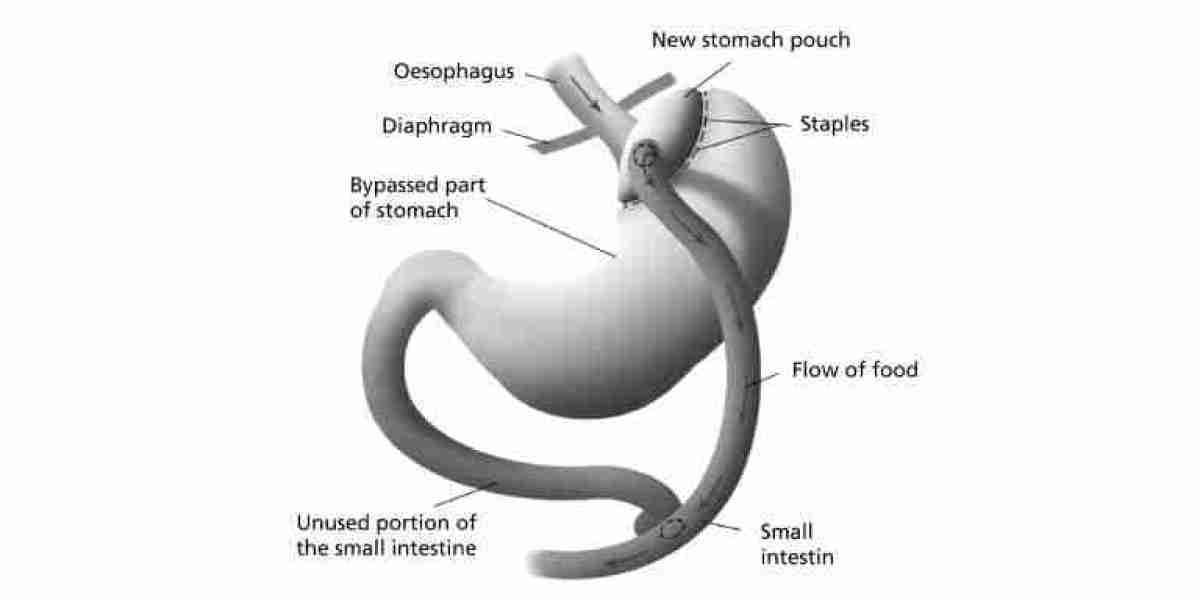 Pregnancy After Gastric Bypass Surgery What Women Should Know