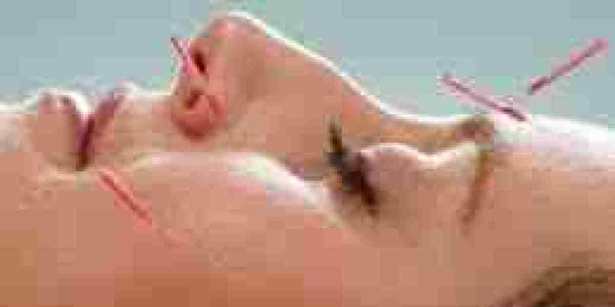 Acupuncture Treatment in Dubai | Process, Benefits & Aftercare
