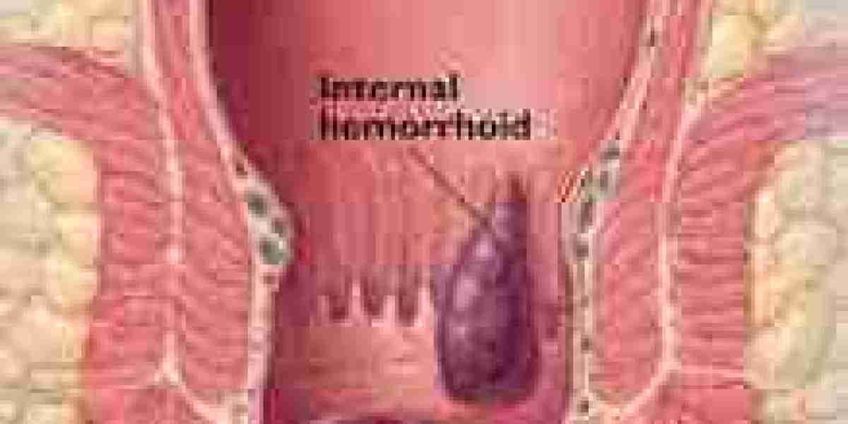 Safe and Effective Haemorrhoids Treatment in Dubai