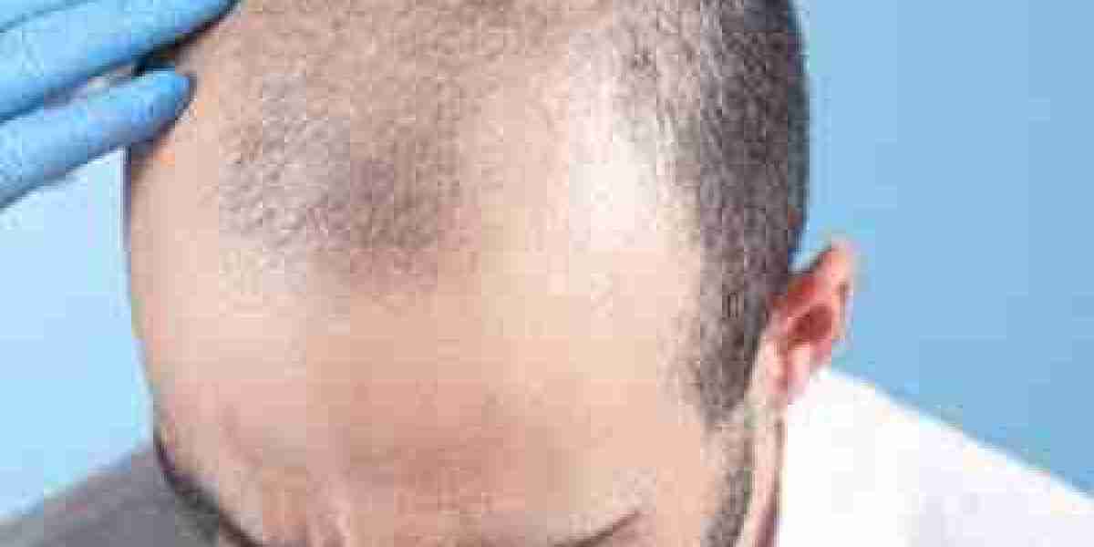 Hair Transplant in Dubai | Transform Your Appearance